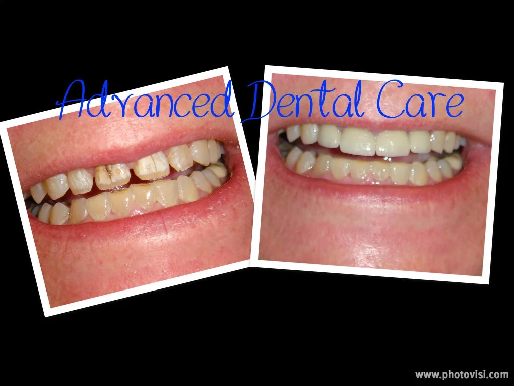 Before & After - Advanced Dental Care Quincy, IL