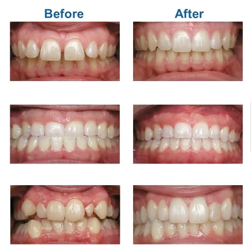 Invisalign - Advanced Dental Care Quincy, IL