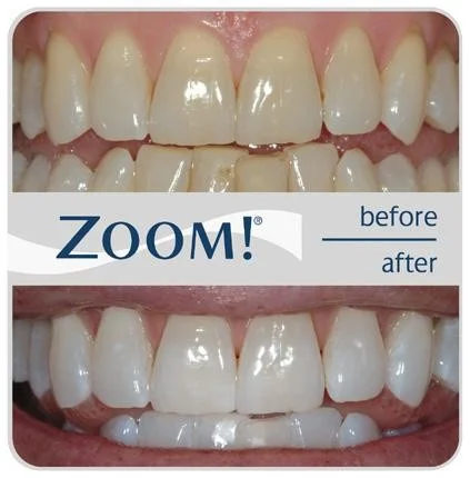 Zoom Dental Whitening - Quincy, IL