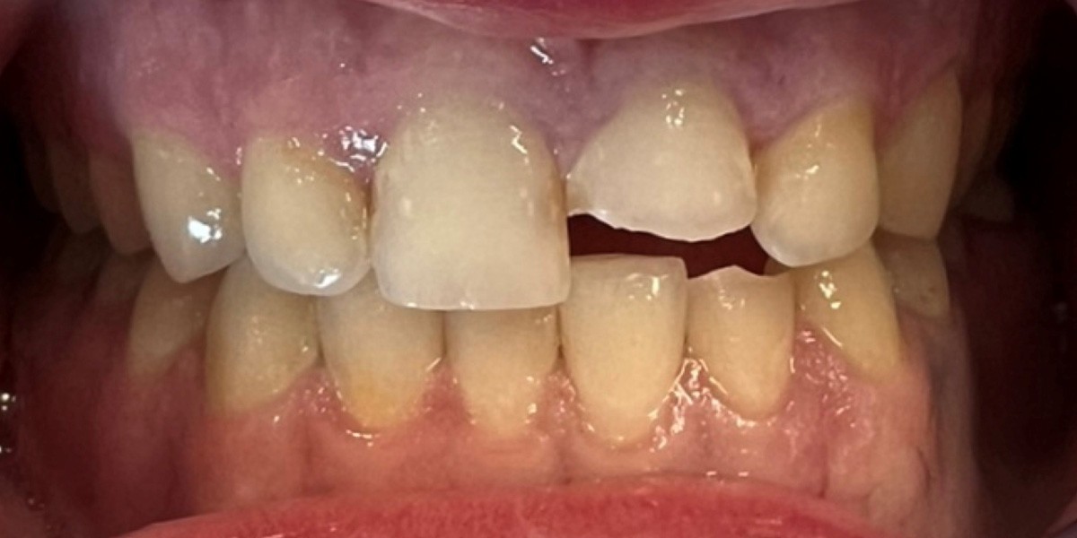 Before Restorative Dentistry - Patient 003