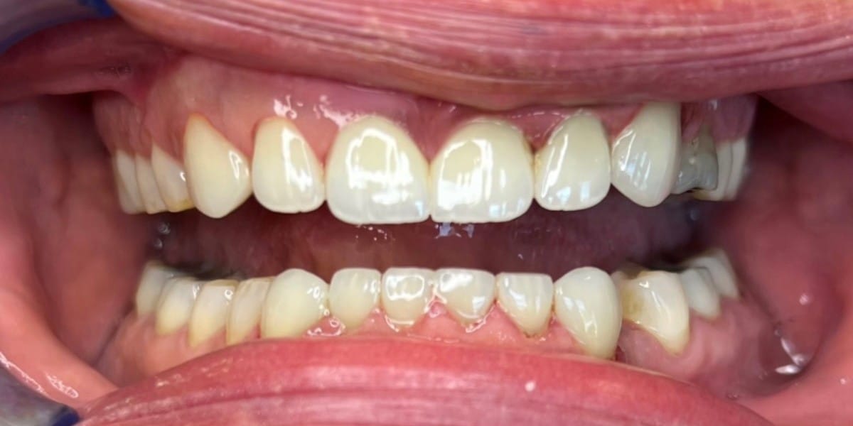 After Restorative Dentistry - Patient 005