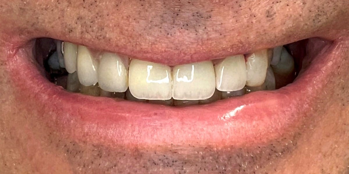 After Restorative Dentistry - Patient 006