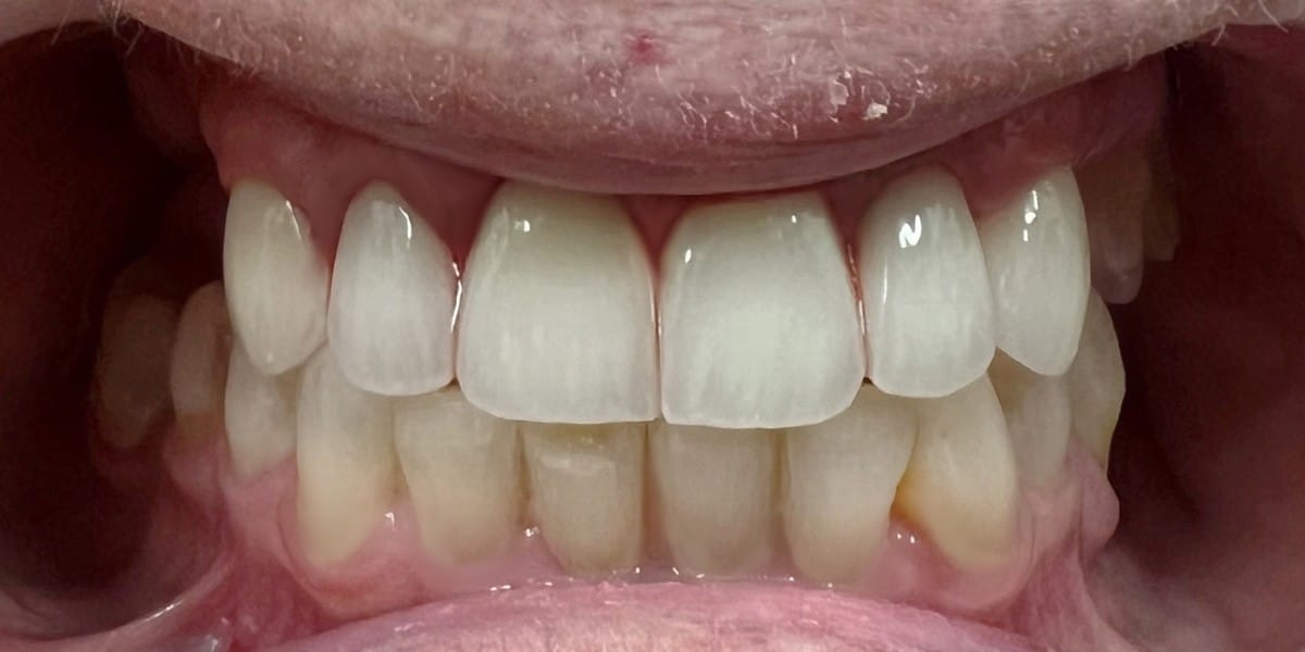 After Restorative Dentistry - Patient 007