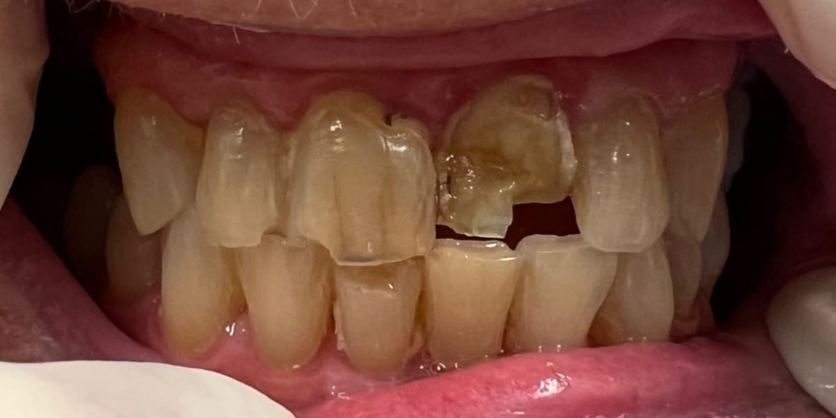 Before Restorative Dentistry - Patient 007